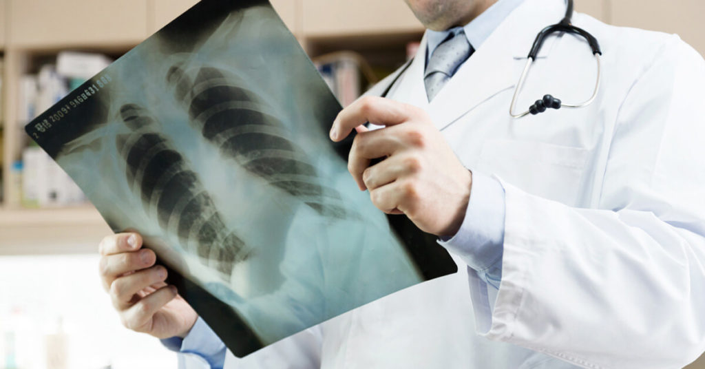 Everything You Need to Know About Mesothelioma and TTFields