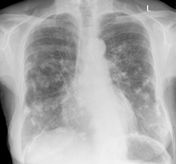 Asbestos Pleural Diseases | Effusion, Plaque & Thickening